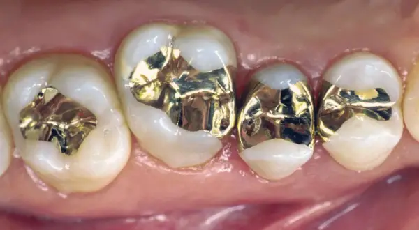Denti con otturazioni in oro, fase di preparazione intarsio dentale.