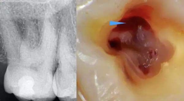 Radiografia e ingrandimento del primo molare superiore con polpa esposta e sanguinante, indicata da una freccia blu.
