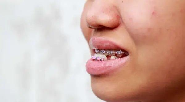 Primo piano di un sorriso con apparecchio ortodontico, inclusi brackets rosa, per correggere un morso inverso.