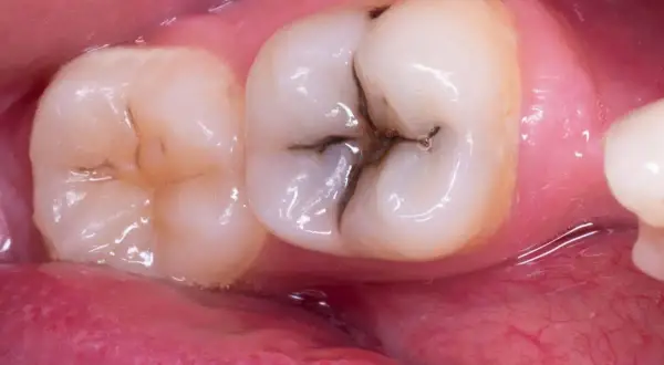 Dente con carie occlusale, un'area scura e profonda nella fessura del dente, che necessita di cure dentali.