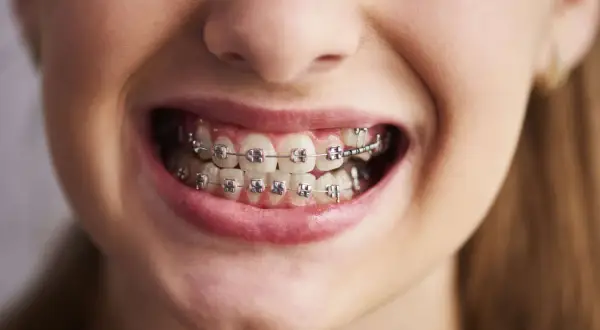 Sorriso di una persona con apparecchio denti. I denti sono allineati con brackets metallici e fili.