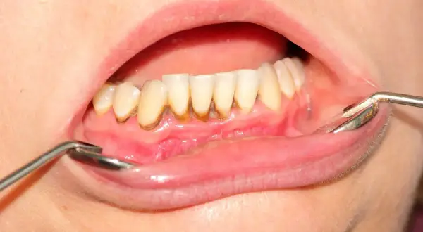 Denti con accumulo di tartaro visibile alla base, evidenziato da uno specchietto dentale.