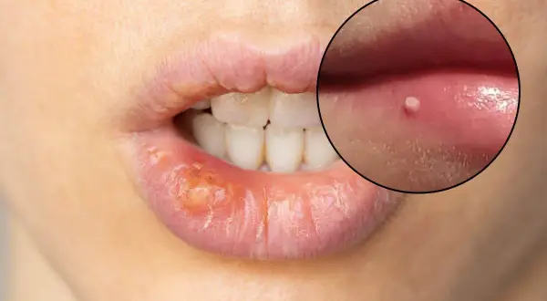 Ingrandimento di labbra con herpes e piccoli puntini bianchi.