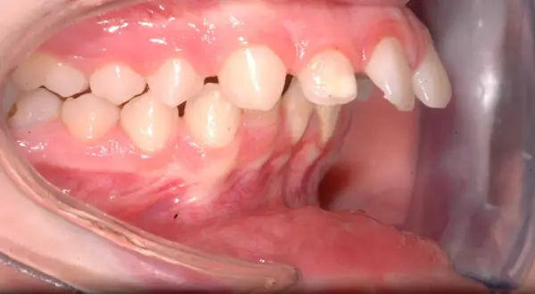 Denti superiori sporgenti e inferiori retratti, un caso di malocclusione 2 classe adulto.