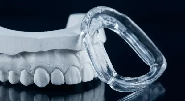 Modello dentale e bite trasparente, soluzione per il bruxismo consigliata dal dentista.
