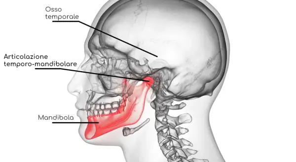 Illustrazione anatomica del cranio che evidenzia l'articolazione temporo-mandibolare, la mandibola (in rosso) e l'osso temporale. Utile per comprendere la disfunzione temporo mandibolare.