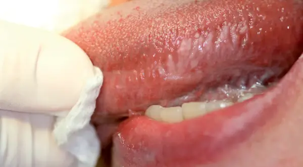 Lingua con lesioni orali, alcune papille gustative appaiono gonfie e arrossate. Un guanto bianco con garza pulisce delicatamente la zona.