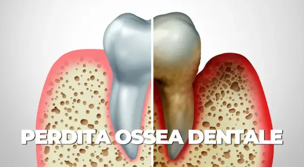 Illustrazione di un dente sano e uno malato, con osso alveolare che mostra riassorbimento osseo alveolare diffuso di tipo orizzontale e verticale.