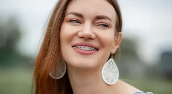 Sorriso smagliante con apparecchio, dimostrando che l'ortodonzia a 50 anni è una scelta di benessere e bellezza.