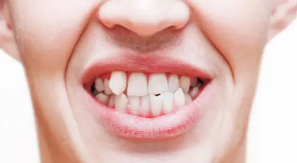 Primo piano di una bocca con labbra arrossate e denti bianchi, alcuni leggermente storti, che sembrano battere per il freddo o la tensione.