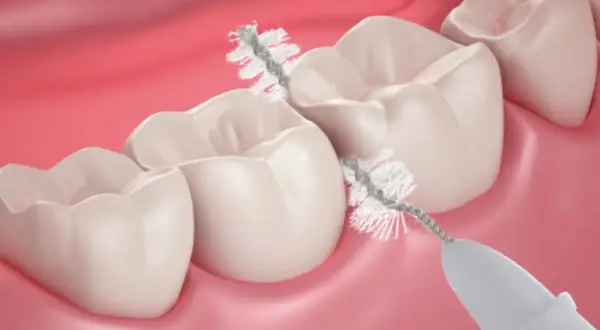 Un piccolo scovolino pulisce con cura gli spazi tra i denti, un'alternativa efficace al filo interdentale per un sorriso smagliante.