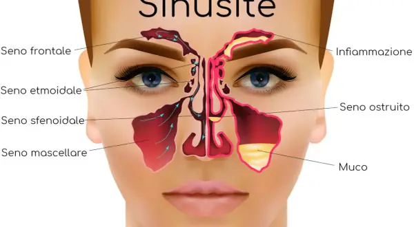 Illustrazione anatomica della sinusite, con enfasi sulla sinusopatia mascellare, mostrando infiammazione e accumulo di muco nei seni paranasali.