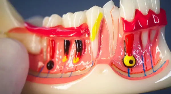 Modello anatomico di denti e gengive, evidenzia il colletto dentale e le strutture sottostanti come nervi e vasi sanguigni.