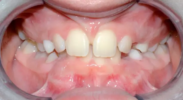 Bocca aperta con denti da latte e il frenulo labiale superiore visibile tra gli incisivi centrali.
