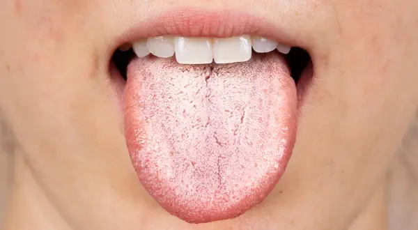 Bocca aperta con lingua che mostra una patina biancastra, quasi una lingua verde per la sua opacità.