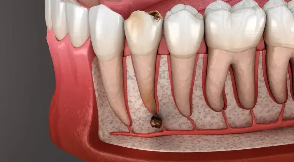 Dente cariato con radice infetta, pronto per l'estrazione. La durata estrazione dente dipende dalla complessità.