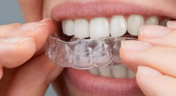 Dita che posizionano un apparecchio invisibile sui denti bianchi.