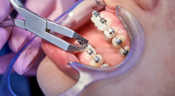 Un dentista usa pinze per sistemare i brackets ortodontici su un dente.