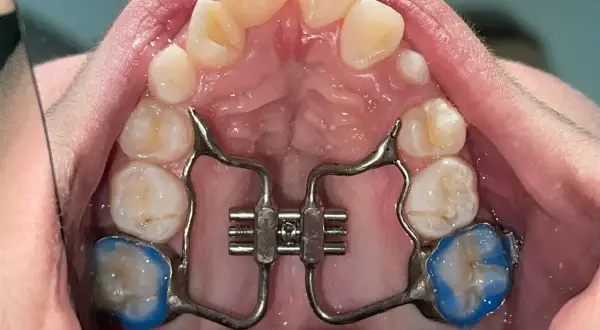 Espansore palato bambini costo: apparecchio ortodontico per allargare il palato, con placchette blu sui molari.