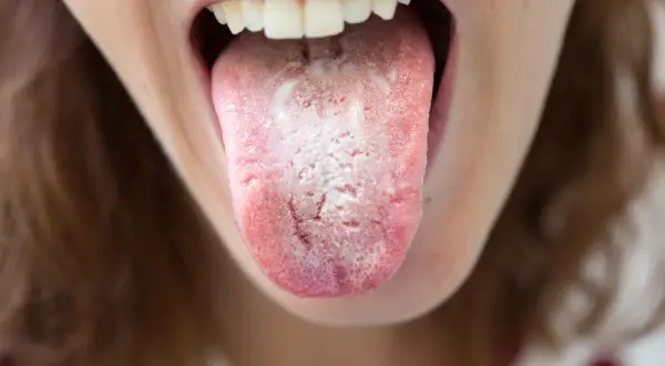 Lingua con patina bianca e rossore, segno di un'infezione da candida che si spera passi da sola.