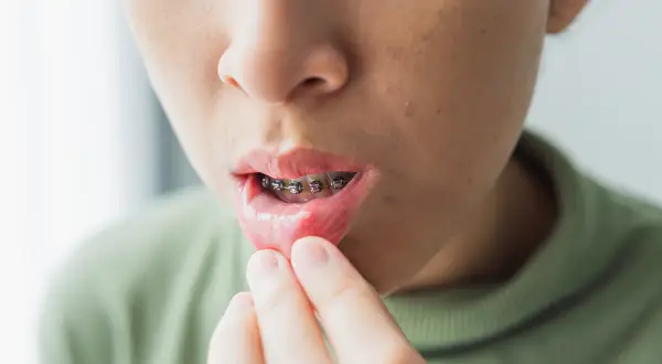 Bocca con apparecchio ortodontico, labbro inferiore irritato e con piccole piaghe da apparecchio ortodontico.