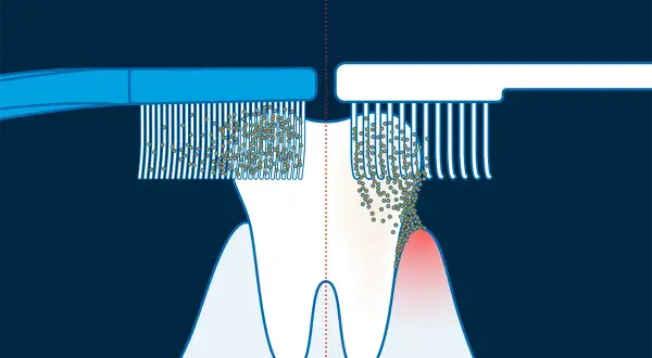 Illustrazione della tecnica di Bass: spazzolino a sinistra pulisce bene, a destra mostra accumulo di placca e gengiva infiammata.