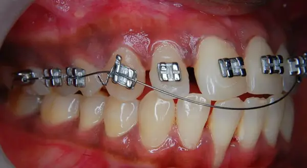 Primo piano di denti con apparecchio fisso. Impossibile togliere l'apparecchio fisso da soli.