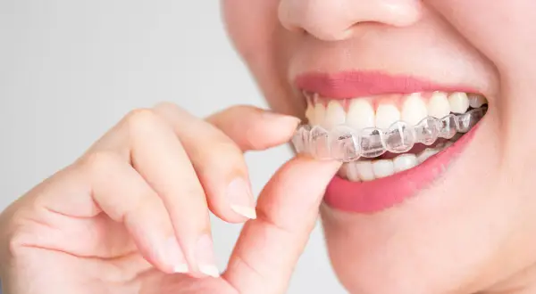 Dettaglio di una bocca con un apparecchio estetico trasparente, che corregge i denti per un sorriso perfetto.
