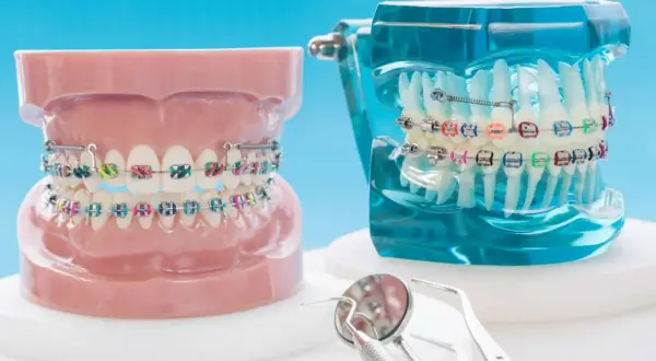 Modelli di denti con apparecchi ortodontici e elastici colorati. Strumenti dentistici in primo piano.