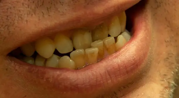 Primo piano di una bocca con denti ingialliti e disallineati, indicativi di una malocclusione di terza classe.