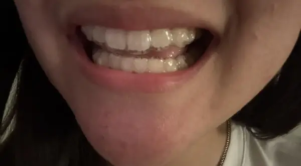 Primo piano di una bocca con apparecchi invisibili e chewies Invisalign per un sorriso perfetto.