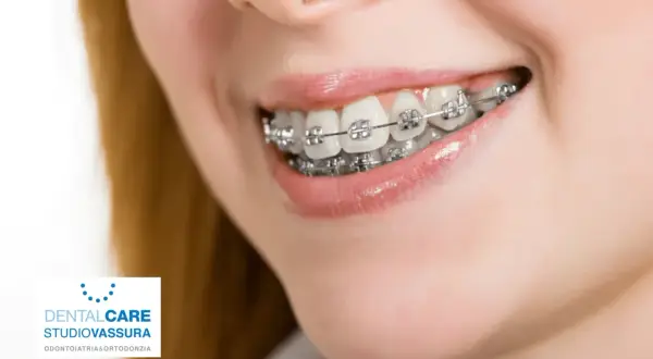 Sorriso con apparecchio ortodontico. L'ortodonzia, il cui significato è allineare i denti, migliora l'estetica e la salute orale.