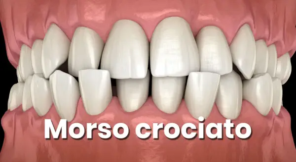 Denti con morso incrociato, una condizione che necessita di correzione ortodontica.