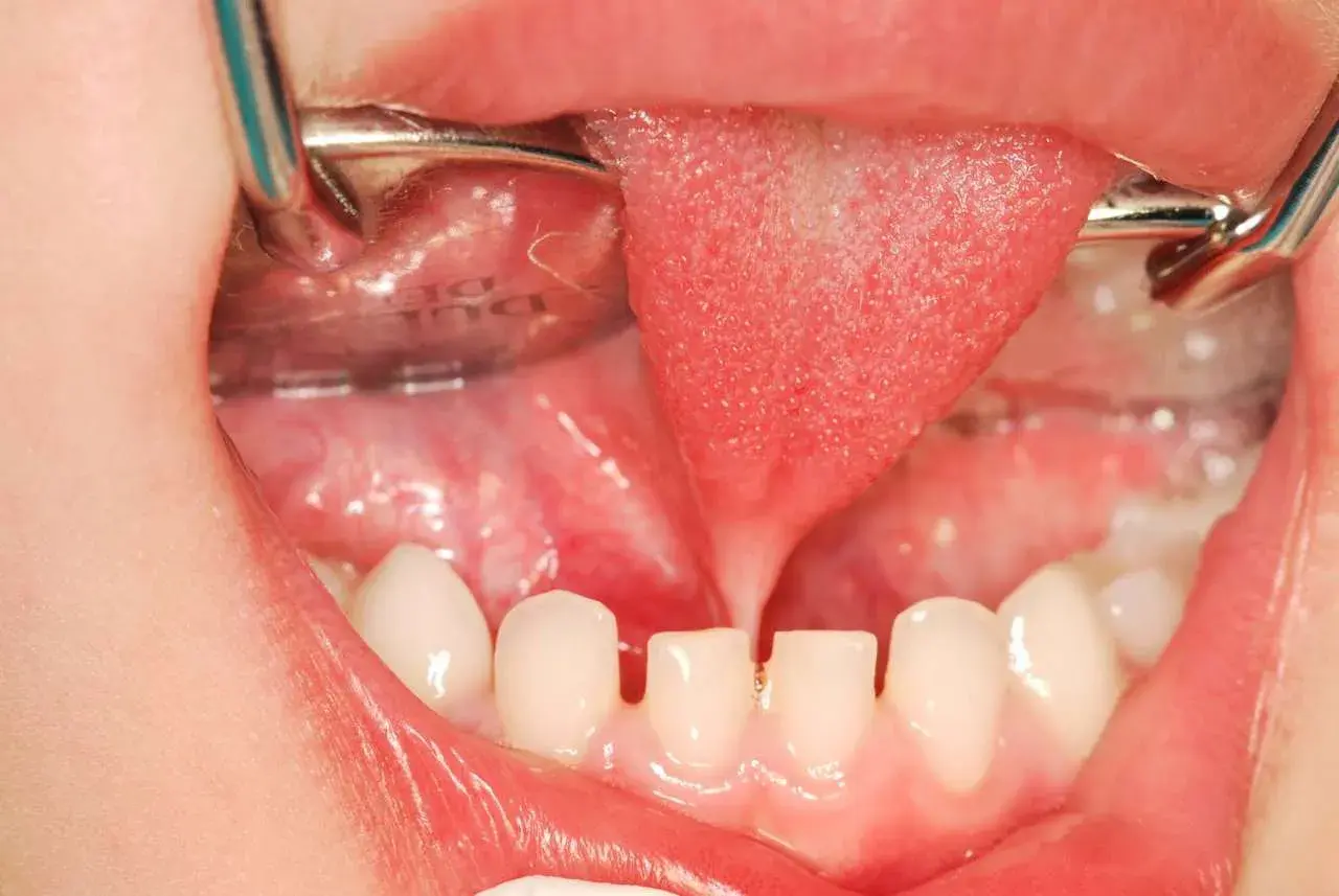 Bocca di bambino con lingua retratta da frenulo linguale corto, denti da latte e strumenti dentistici.