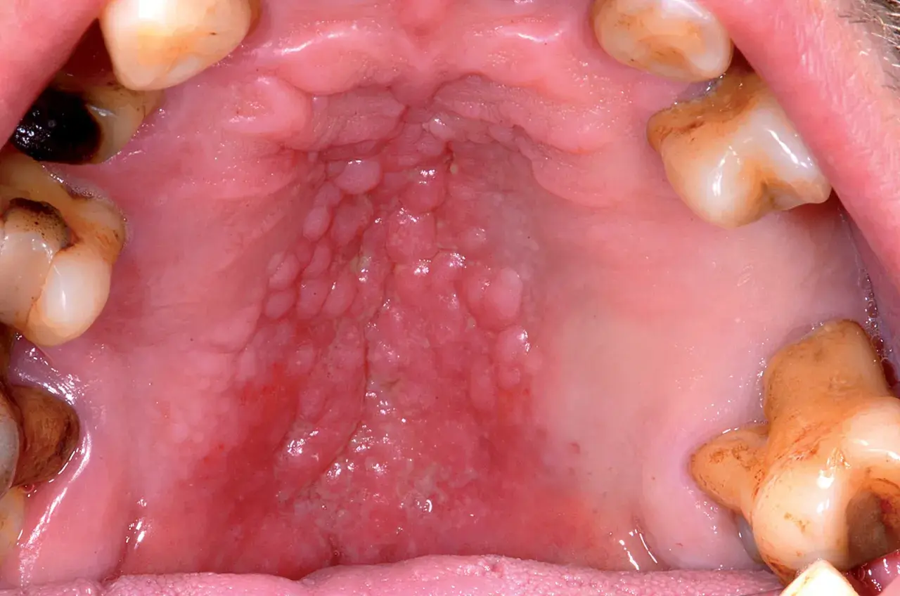 Ingrandimento del palato con un evidente **rilievo sul palato**, caratterizzato da papule e arrossamento.