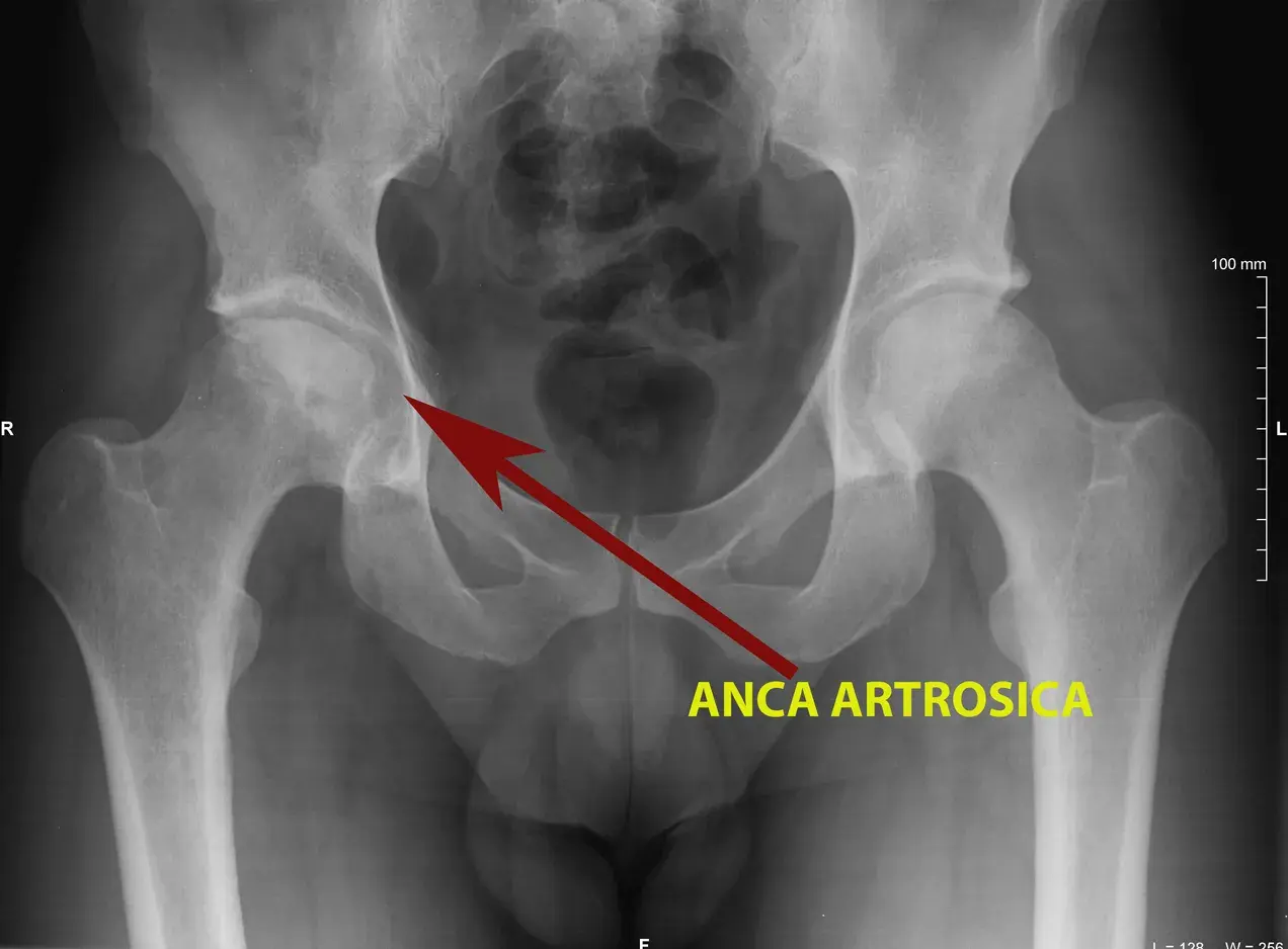 Radiografia del bacino che mostra una rima di radiotrasparenza nell'anca destra, indicata da una freccia rossa e dalla scritta "ANCA ARTROSICA".