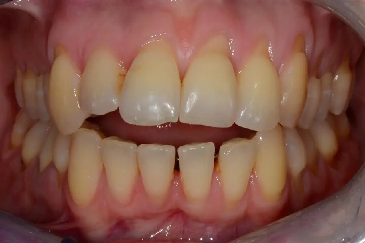 Vista ravvicinata di un morso incrociato laterale in adulti, con denti superiori che coprono quelli inferiori.