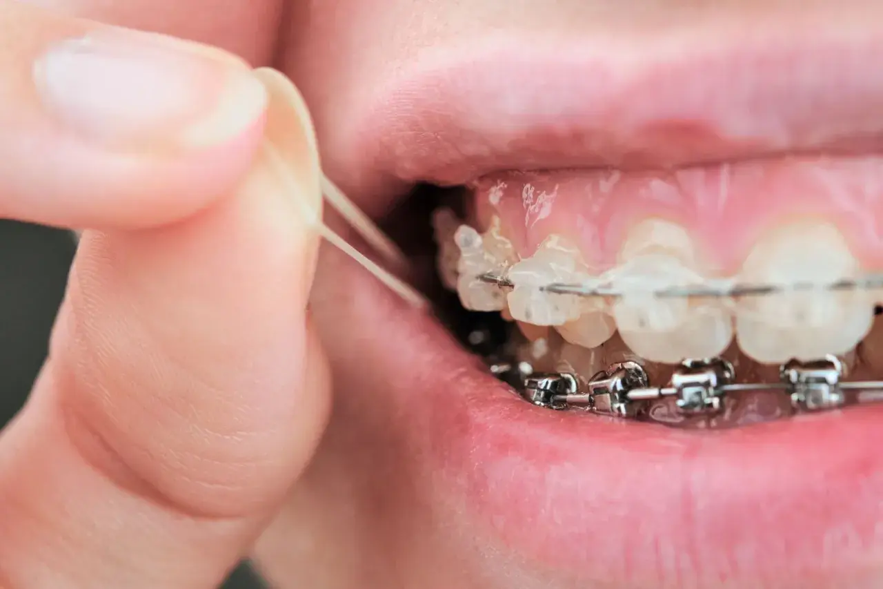 Dita che posizionano elastici sull'apparecchio dentale. A volte gli elastici apparecchio fanno male, ma sono necessari per allineare i denti.