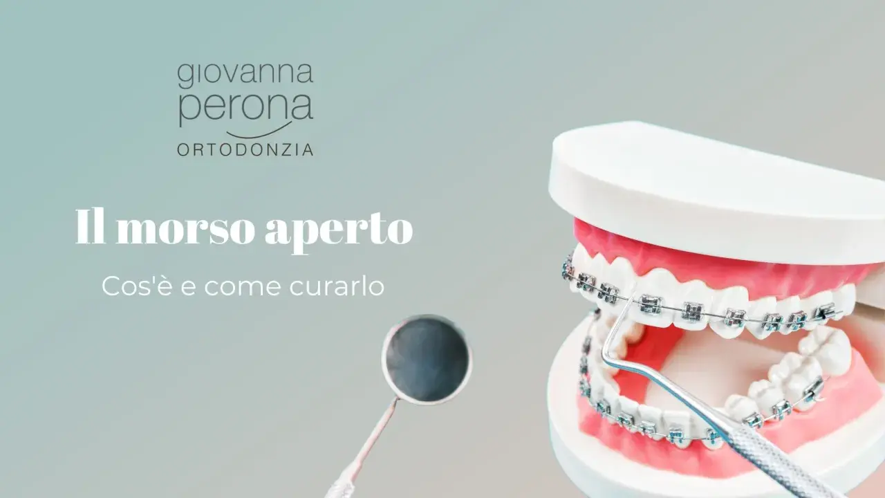 Modello di denti con apparecchio ortodontico mostra un morso aperto. Un dentista esamina il caso.