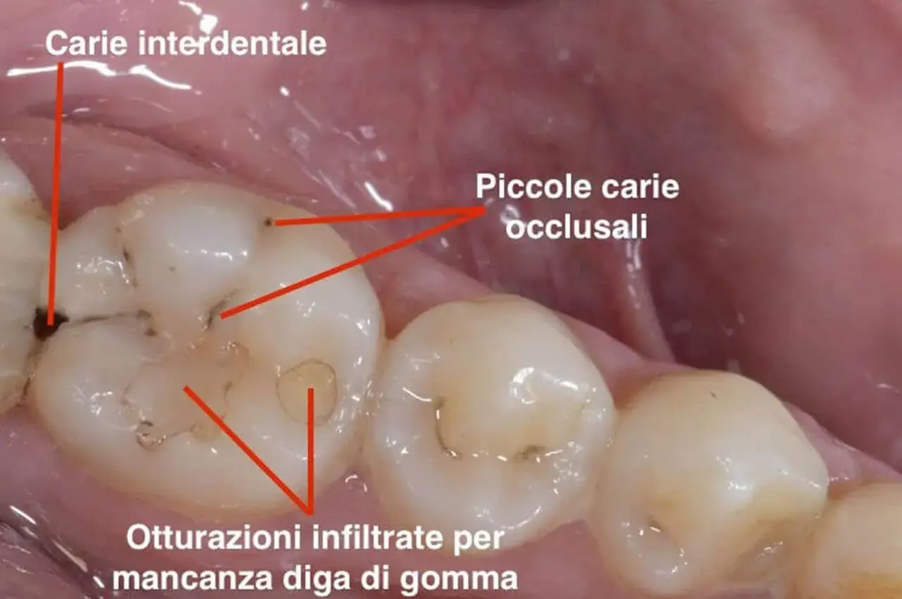 Dente con carie interdentale e piccole carie occlusali. Si nota un puntino nero sul dente, segno di un problema da affrontare.