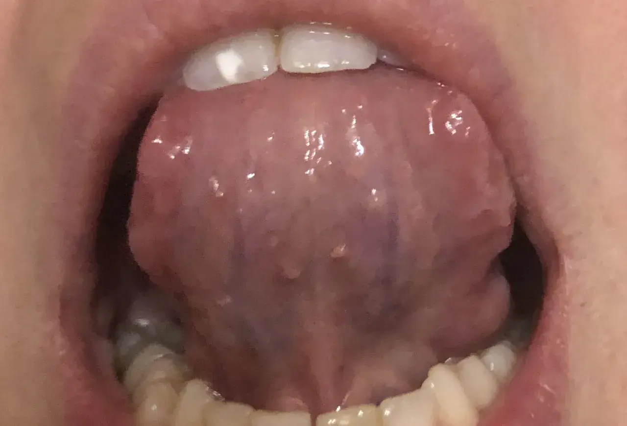 Lingua con piccole protuberanze, forse un papilloma sotto la lingua, visibile con i denti in primo piano.