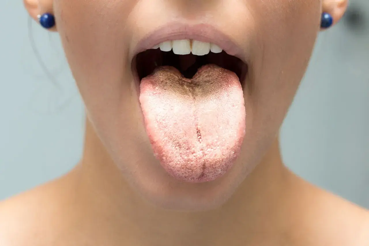 Lingua con patina biancastra e rossastra, possibile sintomo di candida labbra.