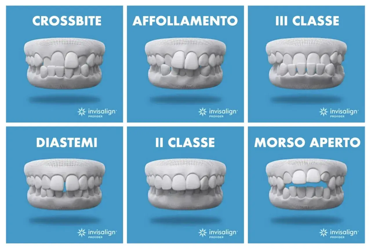 Modelli di denti con problemi: crossbite, affollamento, III classe, diastemi, II classe, morso aperto. Soluzioni Invisalign per correggere.