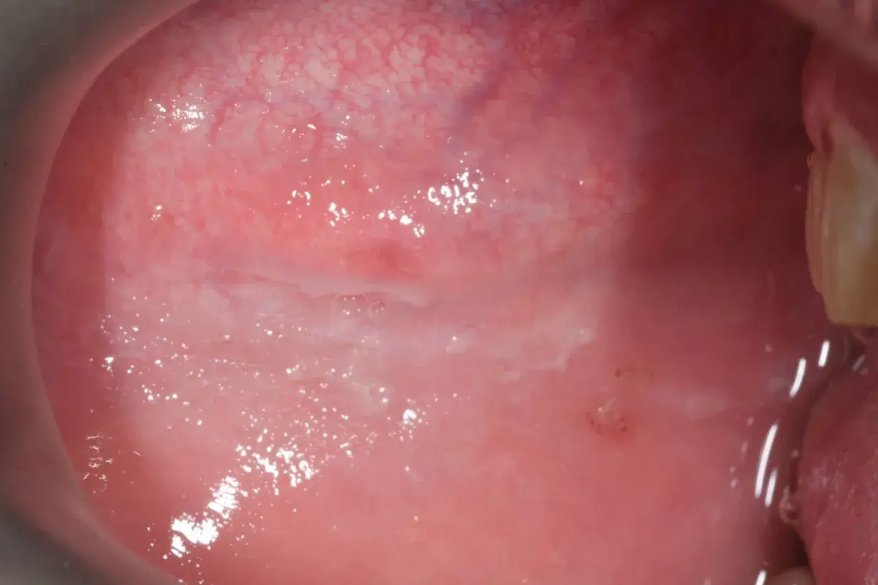 Mucosa orale con aree biancastre e arrossate, indicative di morsicatio buccarum, un'abitudine di mordicchiarsi le guance.