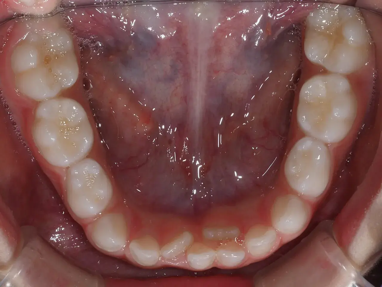 Vista ravvicinata della bocca di un adulto con denti sani, alcuni con piccole bollicine. Si nota una leggera sovrapposizione di alcuni denti, suggerendo una possibile necessità di correzione ortodontica per i denti doppia fila adulti.