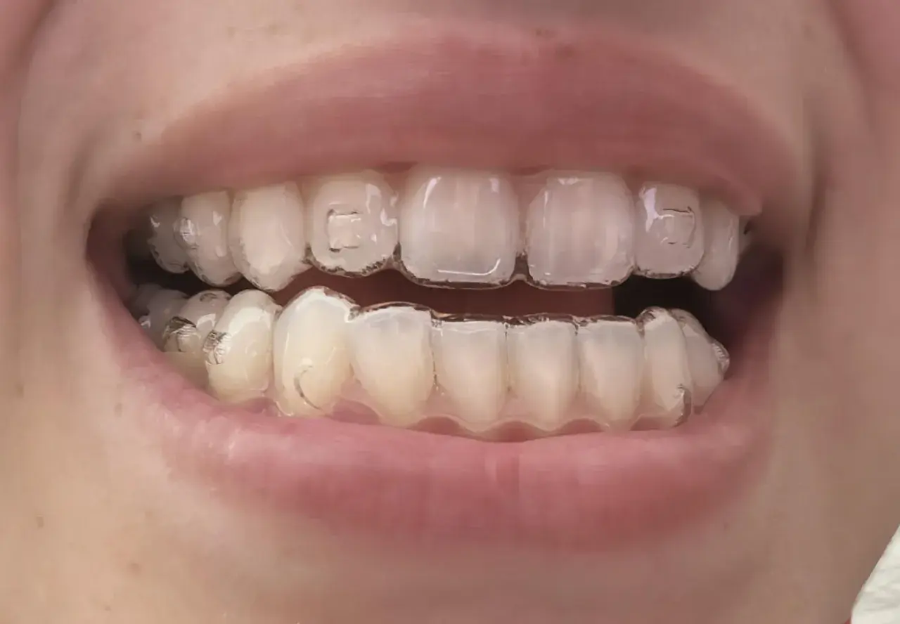 Denti con Invisalign, pronti per mangiare uno yogurt cremoso.