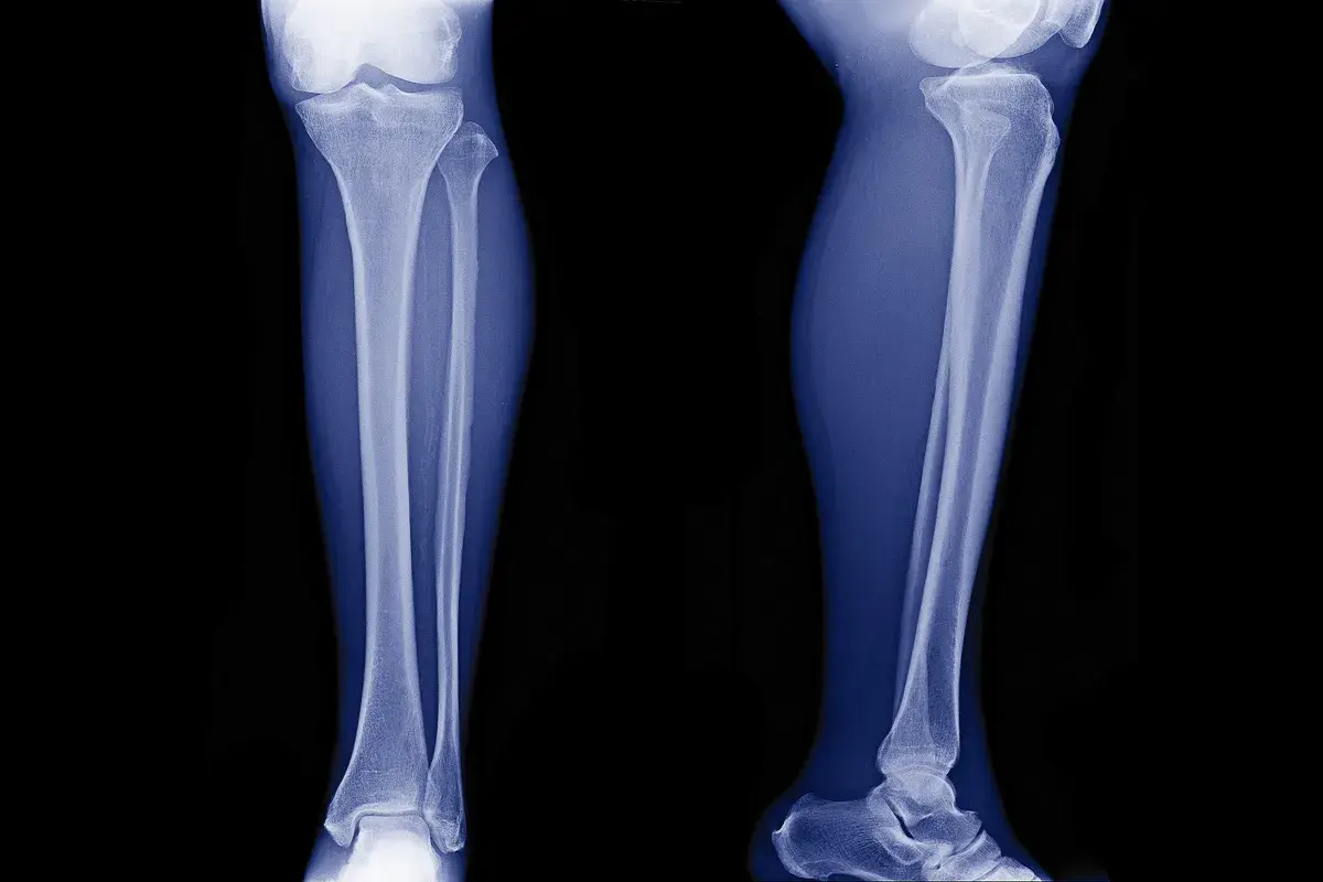 Radiografie delle gambe mostrano un fibroma ossificante, una lesione benigna che coinvolge la tibia e il perone.