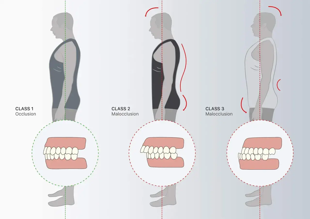 Classi di occlusione dentale: 1 (normale), 2 (malocclusione) e 3 (malocclusione), con profili posturali associati.