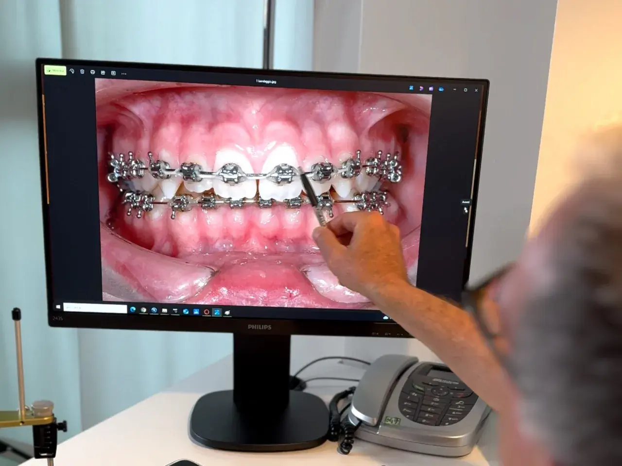 Primo piano di un monitor che mostra un primo piano di denti con apparecchio fisso trasparente. Una mano indica i denti.