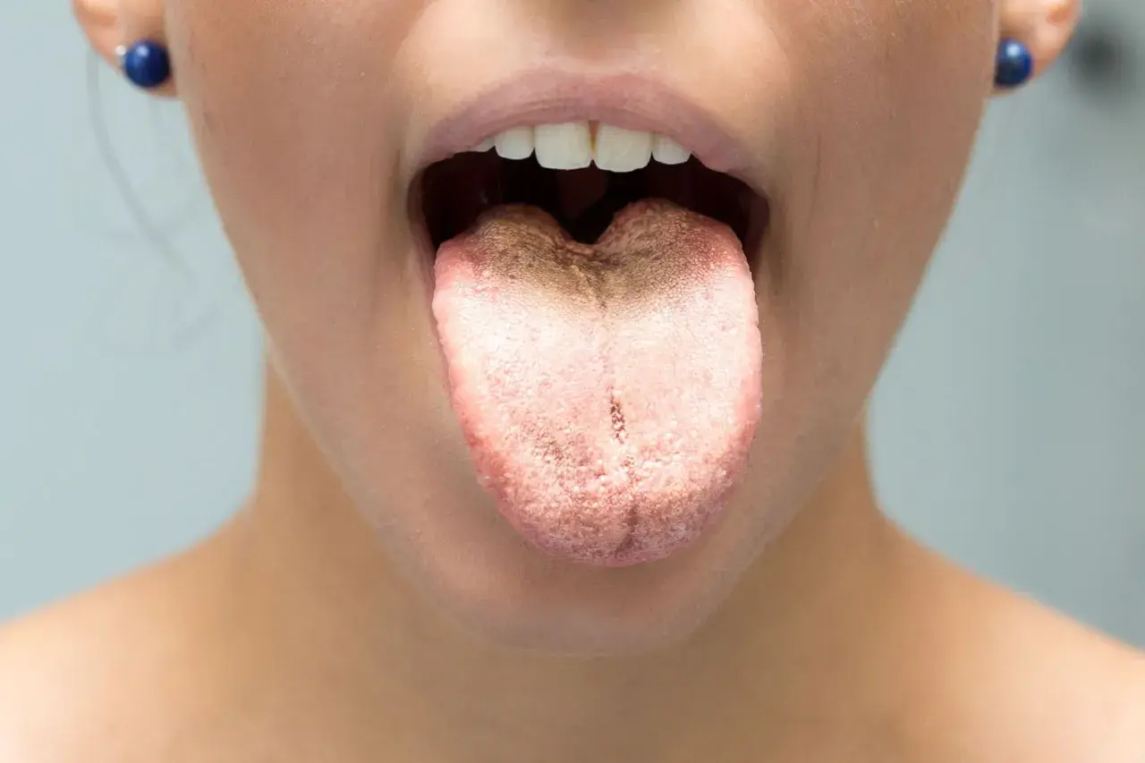 Lingua con patina biancastra, suggerisce sciacqui con bicarbonato per lingua per una pulizia profonda.